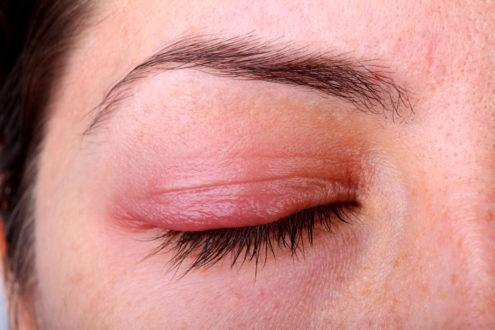 Алергія на очах