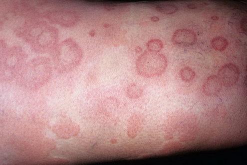 Алергія на шкірі
