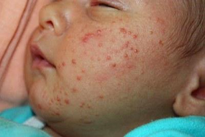 Алергія на обличчі у новонароджених