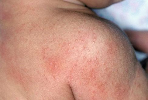Алергія на шкірі у дітей