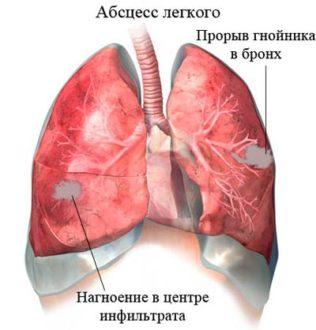 Лікування абсцесу легенів