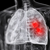 230 Лікування абсцесу легенів