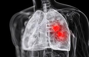 230 Лікування абсцесу легенів