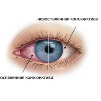 278 Симптоми і лікування аденовірусної інфекції очей