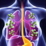 395 Симптоми і лікування актиномікозу легень