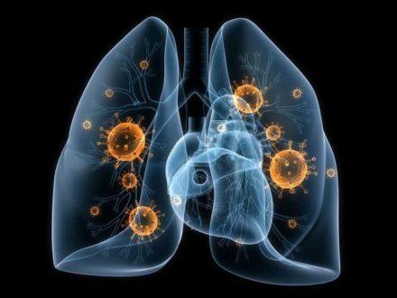 Симптоми і лікування актиномікозу легень
