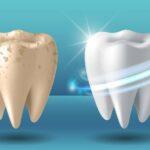 5752 Стоматологи ответили, как отбеливание влияет на здоровье зубов