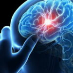 7018 Неврологи научились восстанавливать мозг после инсульта